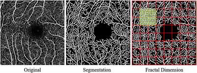 Superficial Macula Capillary Complexity Changes Are Associated With Disability in Neuromyelitis Optica Spectrum Disorders